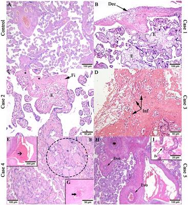 Histopathological and immunological characteristics of placentas infected with chikungunya virus